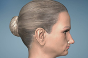 Female Lower Facial Atrophy